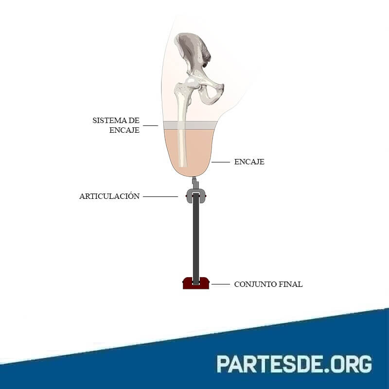 Partes de una prótesis